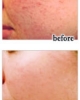 Crema miraculoasa Acnezine